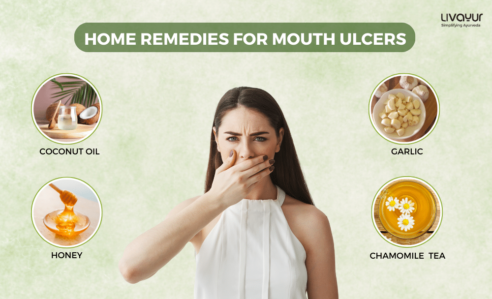 15 Best Home Remedies to Cure Mouth Ulcers Fast 2