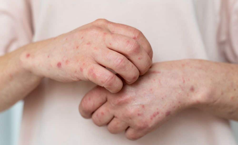 addressing skin diseases - abhrak uses