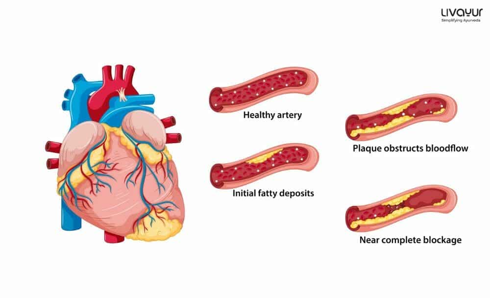 Can Ayurveda Help in Curing Coronary Heart Disease 2